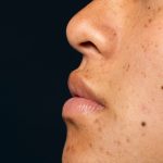 Memahami Hiperpigmentasi, Permasalahan Kulit yang Kerap Buat Kurang Yakin Diri